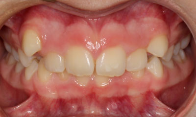 29B Before Picture – Dunn Orthodontics patient
