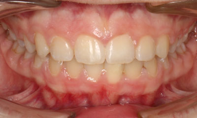 29F After Picture – Dunn Orthodontics patient