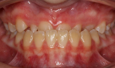 30B Before Picture – Dunn Orthodontics patient