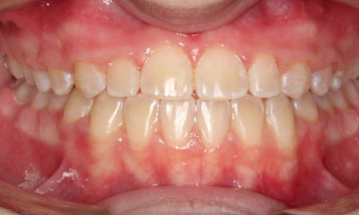 30F After Picture – Dunn Orthodontics patient