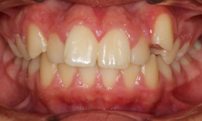 31B Before Picture – Dunn Orthodontics patient