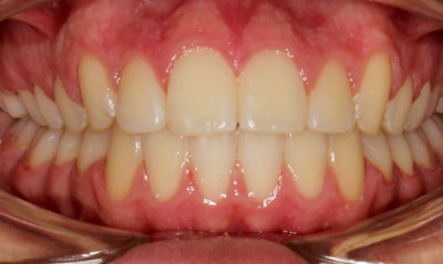 31F After Picture – Dunn Orthodontics patient