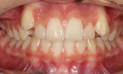 32B Before Picture – Dunn Orthodontics patient