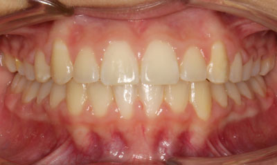 32F After Picture – Dunn Orthodontics patient