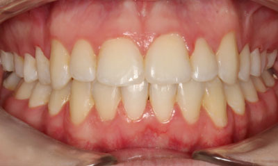33F After Picture – Dunn Orthodontics patient