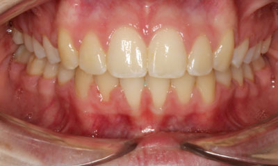 35F After Picture – Dunn Orthodontics patient