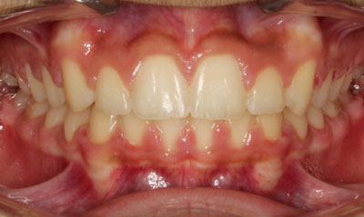 36F After Picture – Dunn Orthodontics patient