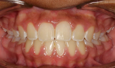 37F After Picture – Dunn Orthodontics patient